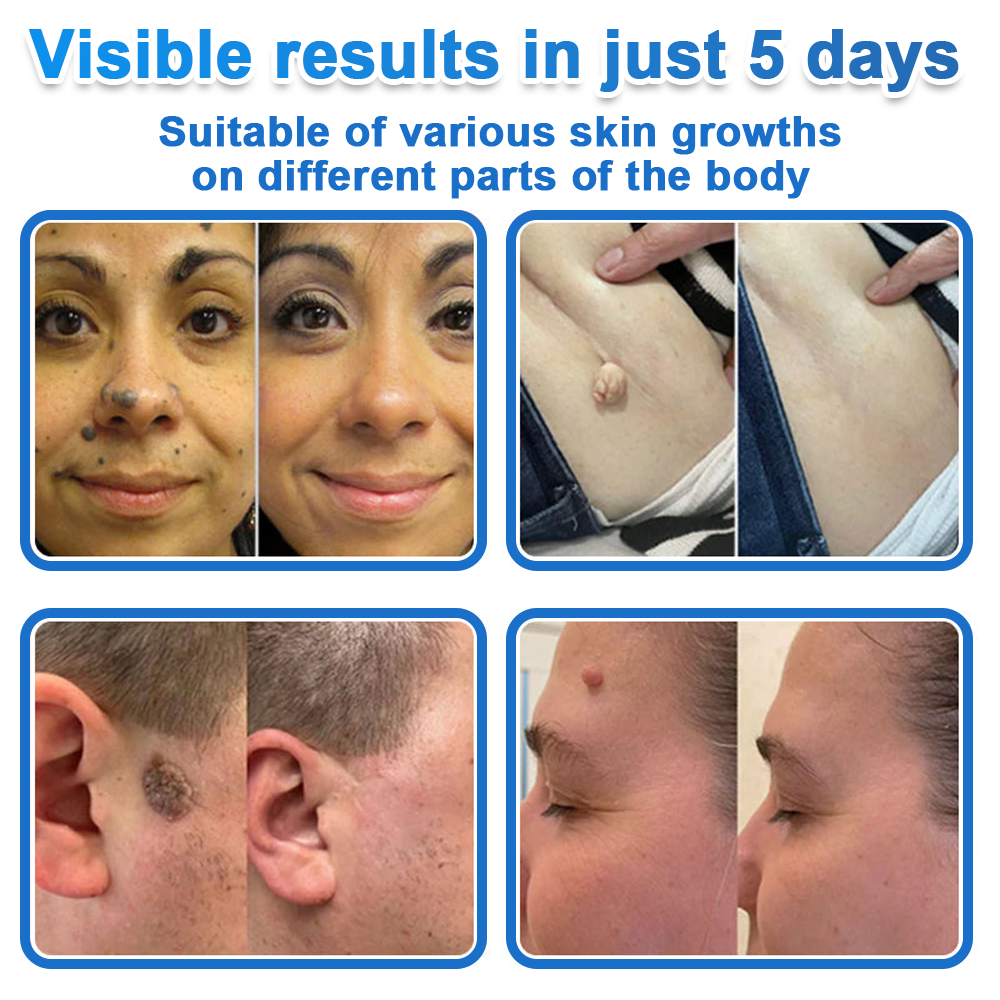 HISKIN® 2-in-1 Microneedle Hydrocolloid Patches | Helps Improve Raised Moles, Acne, Flat Warts & Skin Tags | Targets Fine Lines, Scars & Skin Imperfections | Invisible Face & Body Blemish Patches