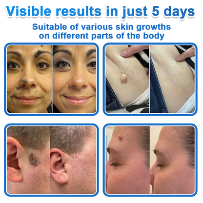 HISKIN® 2-in-1 Microneedle Hydrocolloid Patches | Helps Improve Raised Moles, Acne, Flat Warts & Skin Tags | Targets Fine Lines, Scars & Skin Imperfections | Invisible Face & Body Blemish Patches