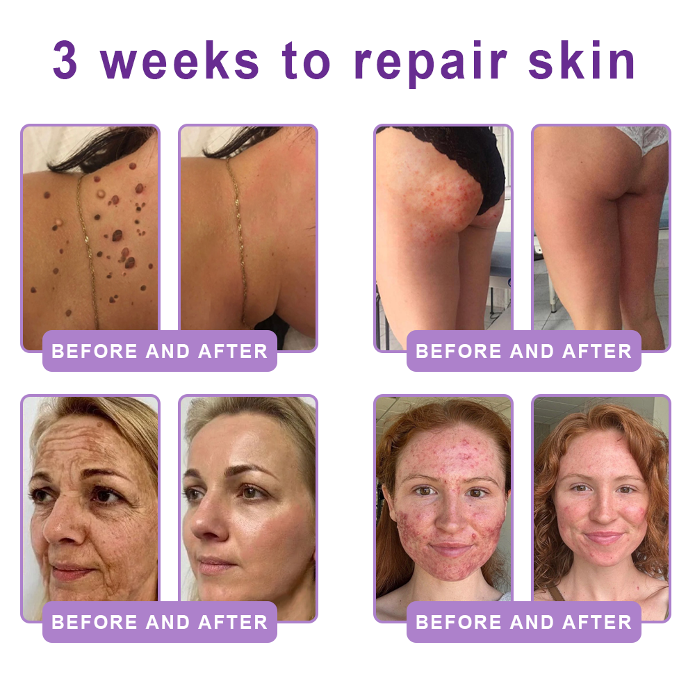 HISKIN® ---Only 10 boxes! Grab an exclusive 30% discount now! Keep your skin youthful and glowing in just 1 to 3 weeks. Don’t miss your chance—this offer won’t come around again until next year. Act fast! 180-day money back guarantee!🔥