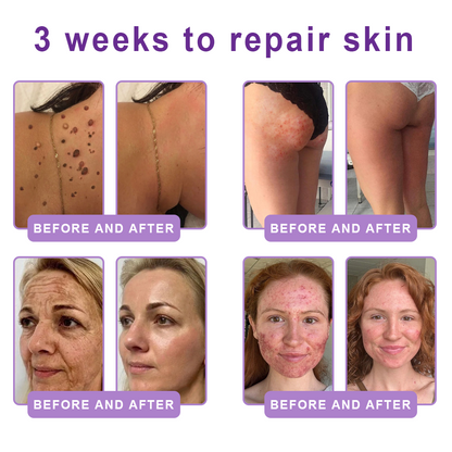 HISKIN® ---Only 10 boxes! Grab an exclusive 30% discount now! Keep your skin youthful and glowing in just 1 to 3 weeks. Don’t miss your chance—this offer won’t come around again until next year. Act fast! 180-day money back guarantee!🔥
