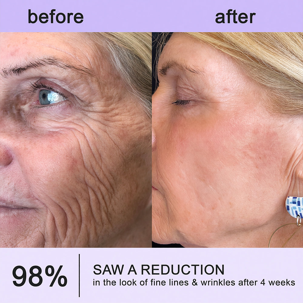 Himilk® Bee Venom & Botox Wrinkle-Lift Tightening Cream 🐝 (Anti-Aging,Hydration, Skin Repair, Acne & Dark Spot Treatment, Wart & Mole Removal, Psoriasis Relief) 🌸