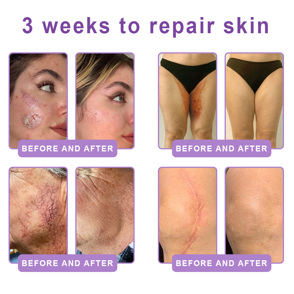 HISKIN® ---Only 10 boxes! Grab an exclusive 30% discount now! Keep your skin youthful and glowing in just 1 to 3 weeks. Don’t miss your chance—this offer won’t come around again until next year. Act fast! 180-day money back guarantee!🔥