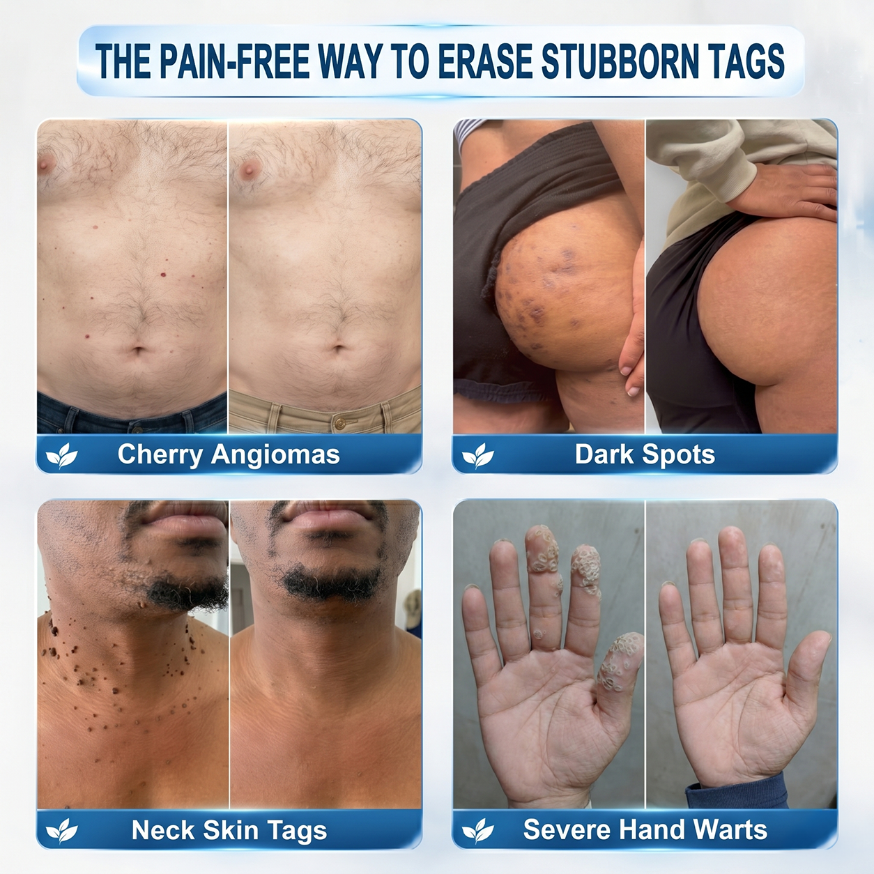 𝐇𝐈𝐒𝐊𝐈𝐍®👨‍⚕️ 𝟕-𝐃𝒂𝘆 𝐒𝗸𝐢𝐧 𝐓𝒂𝗴 & 𝐒𝐩𝙤𝐭 𝐄𝐫𝒂𝐬𝙚𝐫 Painless & Scar-Free Advanced Imperfection Removal Rollerball Pen