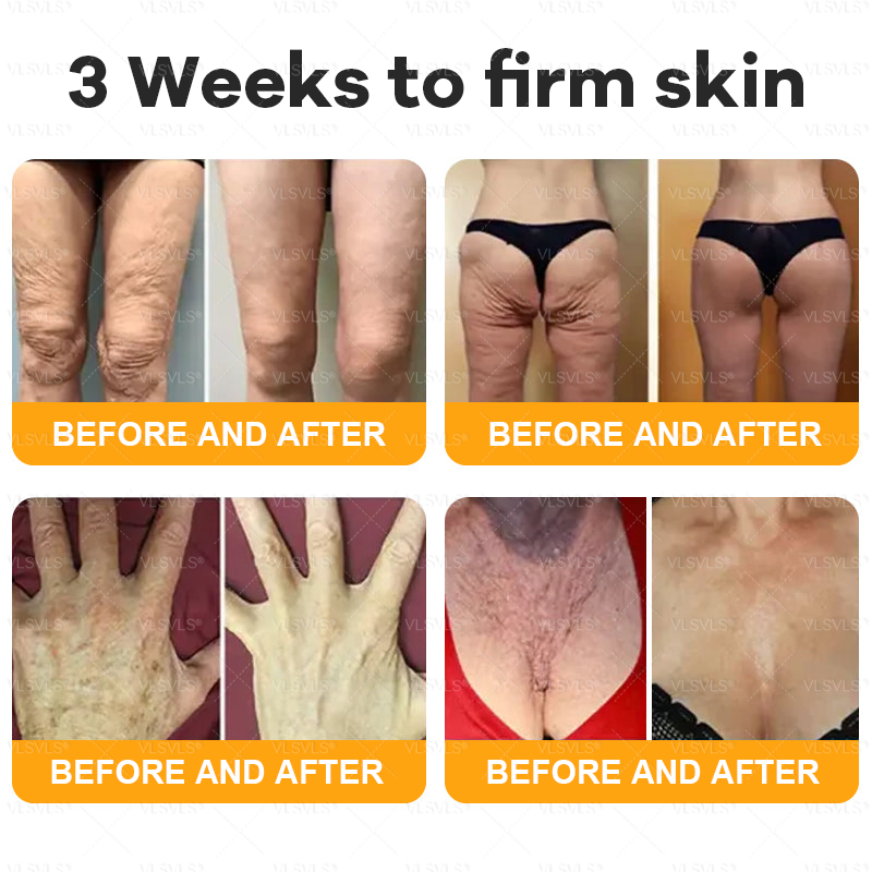 𝙑𝙇𝙎𝙑𝙇𝙎® 𝘽𝙀𝙀 𝙑𝙀𝙉𝙊𝙈 𝑺𝒌𝒊𝒏 𝑹𝒆𝒔𝒕𝒐𝒓𝒂𝒕𝒊𝒐𝒏 𝑪𝒓𝒆𝒂𝒎 –🌸 Anti-aging,Hydrating, Skin Repair, Even Tone, Acne and Dark Spot Treatment, Wart and Mole Removal, Psoriasis Relief