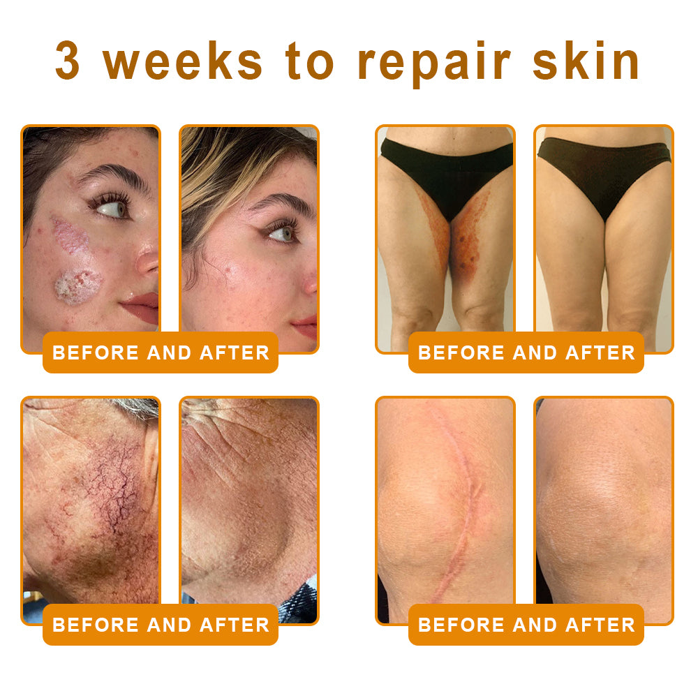𝑷𝑼𝑹𝑶𝑺𝑨® 𝘽𝙀𝙀 𝙑𝙀𝙉𝙊𝙈 𝙎𝙠𝙞𝙣 𝙍𝙚𝙨𝙩𝙤𝙧𝙖𝙩𝙞𝙤𝙣 𝘾𝙧𝙚𝙖𝙢 –🌸 Anti-aging,Hydrating, Skin Repair, Even Tone, Acne and Dark Spot Treatment, Wart and Mole Removal, Psoriasis Relief