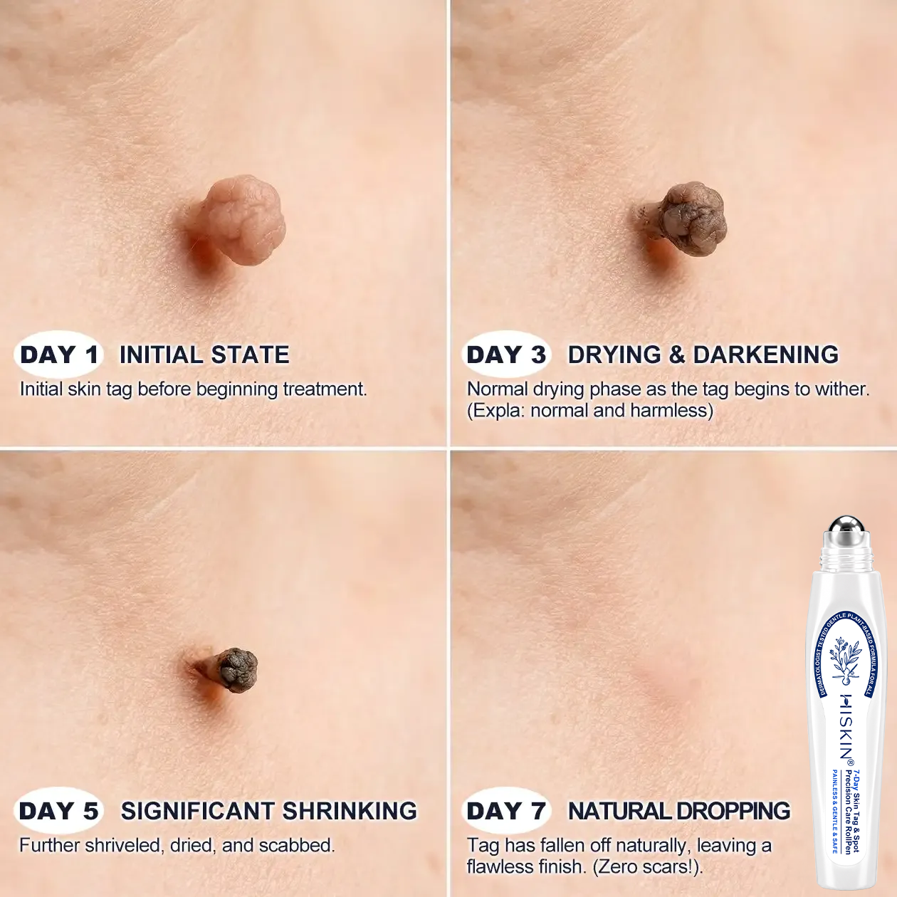 𝐇𝐈𝐒𝐊𝐈𝐍®👨‍⚕️ 𝟕-𝐃𝒂𝘆 𝐒𝗸𝐢𝐧 𝐓𝒂𝗴 & 𝐒𝐩𝙤𝐭 𝐄𝐫𝒂𝐬𝙚𝐫 Painless & Scar-Free Advanced Imperfection Removal Rollerball Pen