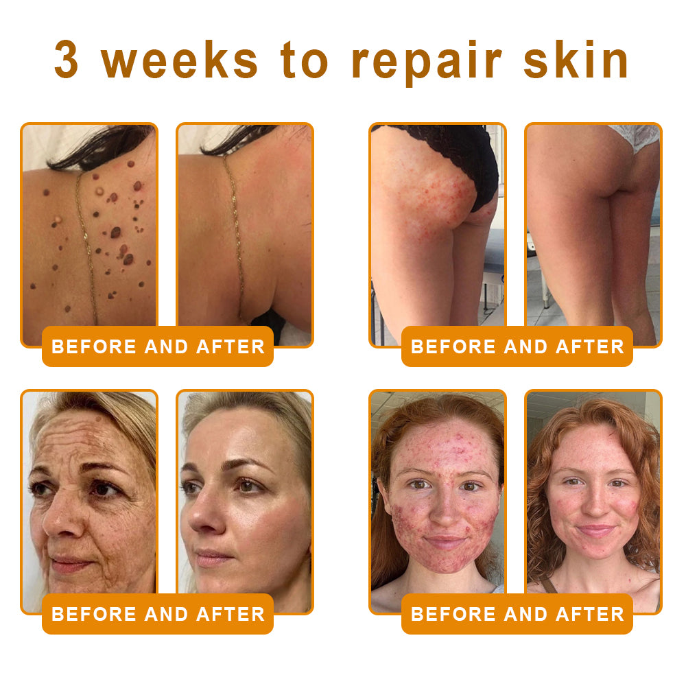 𝙑𝙇𝙎𝙑𝙇𝙎® 𝘽𝙀𝙀 𝙑𝙀𝙉𝙊𝙈 𝑺𝒌𝒊𝒏 𝑹𝒆𝒔𝒕𝒐𝒓𝒂𝒕𝒊𝒐𝒏 𝑪𝒓𝒆𝒂𝒎 –🌸 Anti-aging,Hydrating, Skin Repair, Even Tone, Acne and Dark Spot Treatment, Wart and Mole Removal, Psoriasis Relief