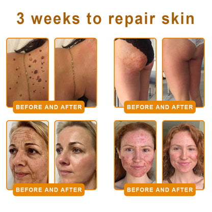 𝙑𝙇𝙎𝙑𝙇𝙎® 𝘽𝙀𝙀 𝙑𝙀𝙉𝙊𝙈 𝑺𝒌𝒊𝒏 𝑹𝒆𝒔𝒕𝒐𝒓𝒂𝒕𝒊𝒐𝒏 𝑪𝒓𝒆𝒂𝒎 –🌸 Anti-aging,Hydrating, Skin Repair, Even Tone, Acne and Dark Spot Treatment, Wart and Mole Removal, Psoriasis Relief