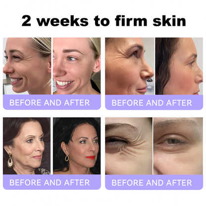 Himilk® Bee Venom & Botox Wrinkle-Lift Tightening Cream 🐝 (Anti-Aging,Hydration, Skin Repair, Acne & Dark Spot Treatment, Wart & Mole Removal, Psoriasis Relief) 🌸