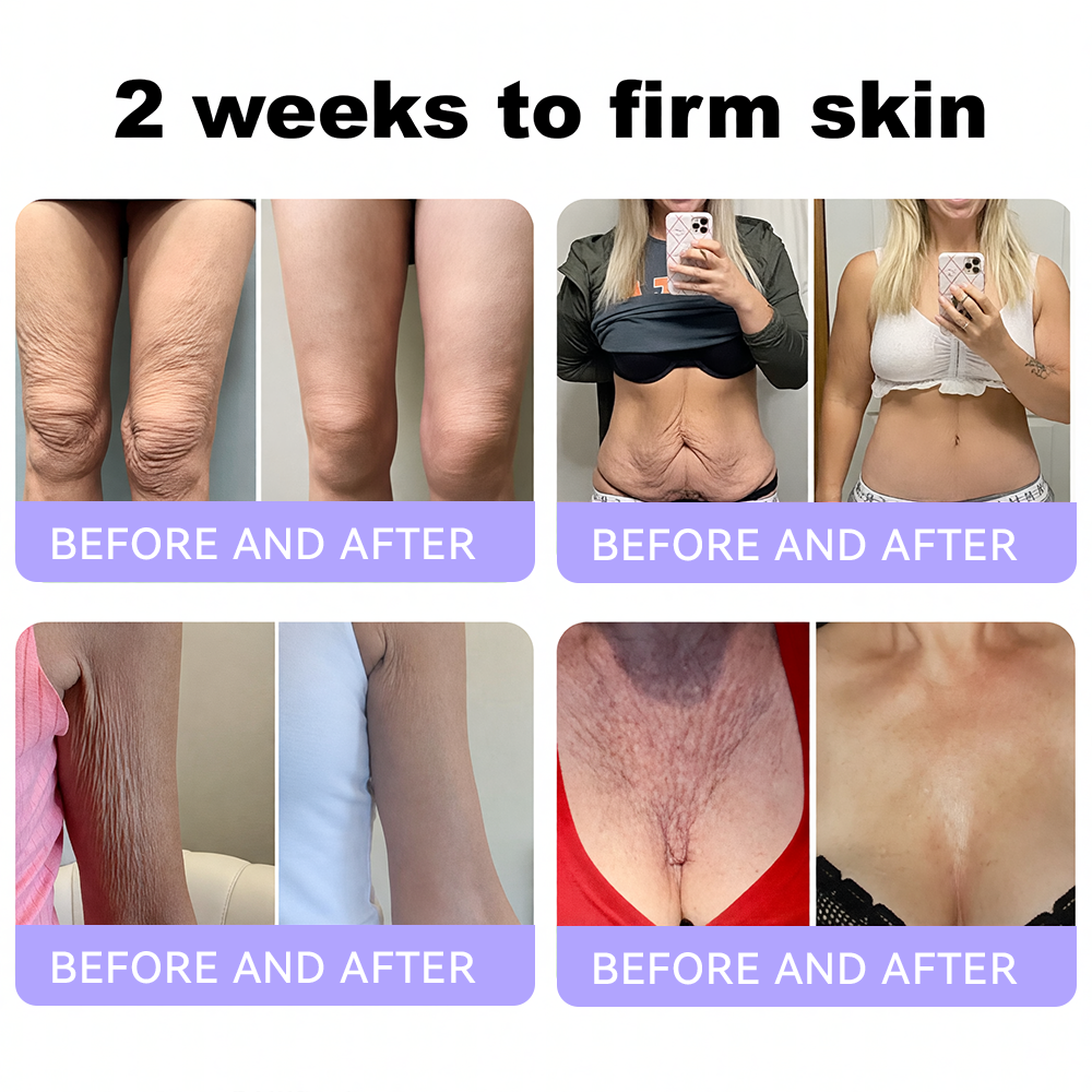 Himilk® Bee Venom & Botox Wrinkle-Lift Tightening Cream 🐝 (Anti-Aging,Hydration, Skin Repair, Acne & Dark Spot Treatment, Wart & Mole Removal, Psoriasis Relief) 🌸